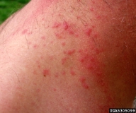 Skin rash from contact with browntail moth caterpillars